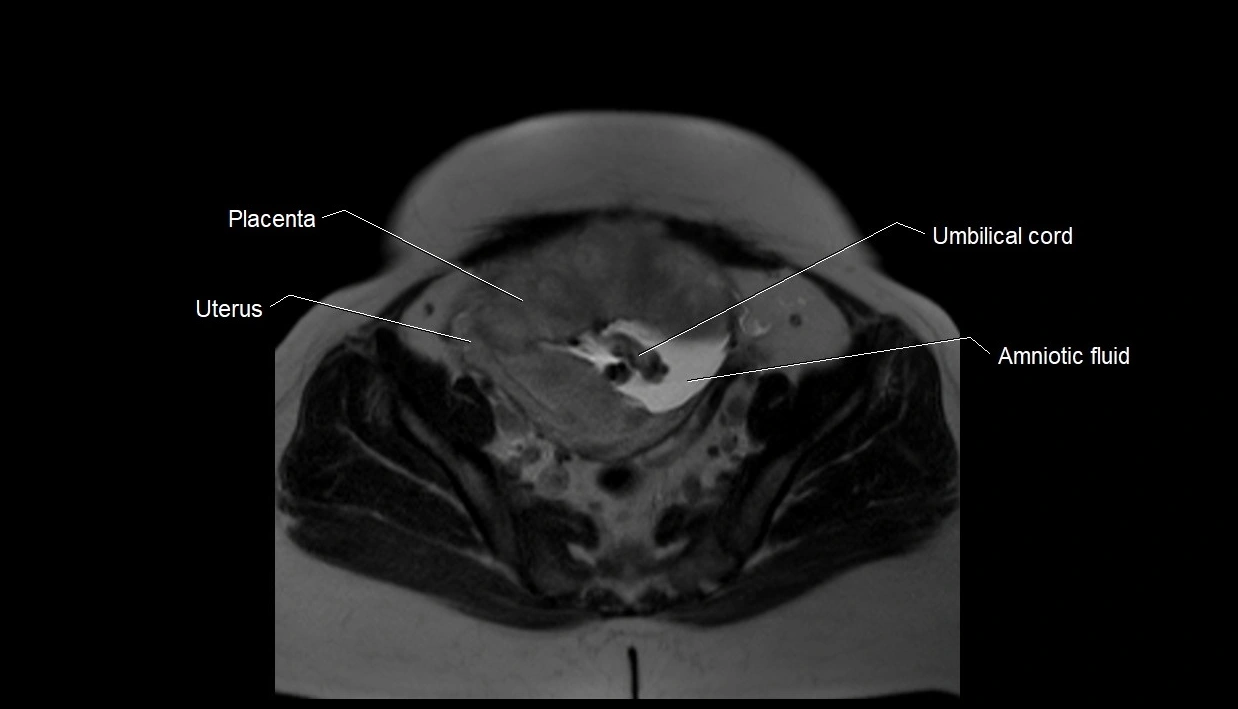 MRI fetal anatomy axial image 31.webp